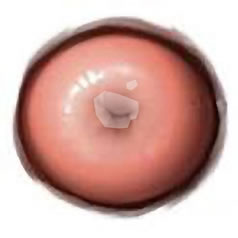 Cervix Aceto-white Appearance