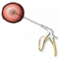 Punch Biopsy Illustration