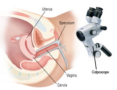 Colposcopy Diagram